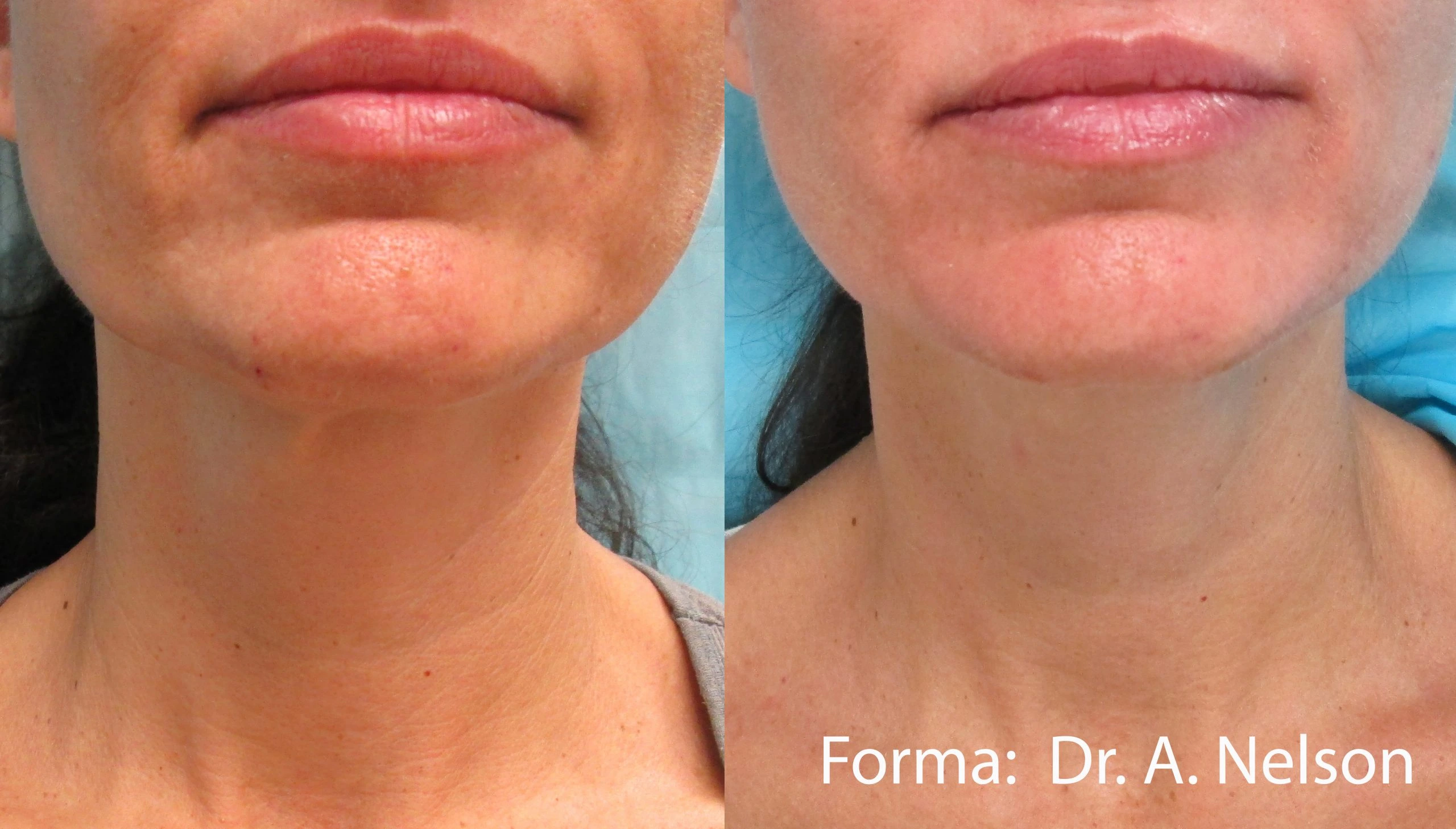 forma-before-after-dr-a-nelson-preview-4 (1)