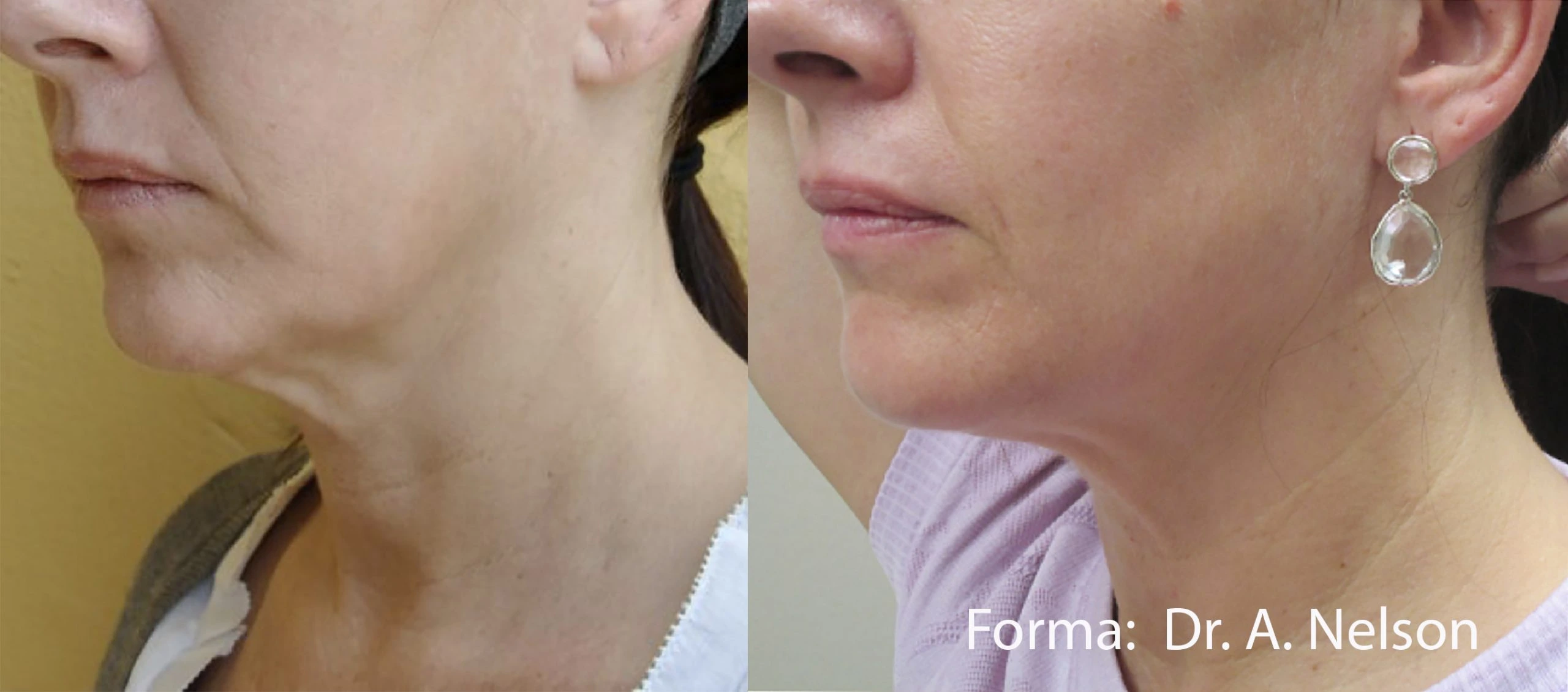 forma-before-after-dr-a-nelson-preview-1