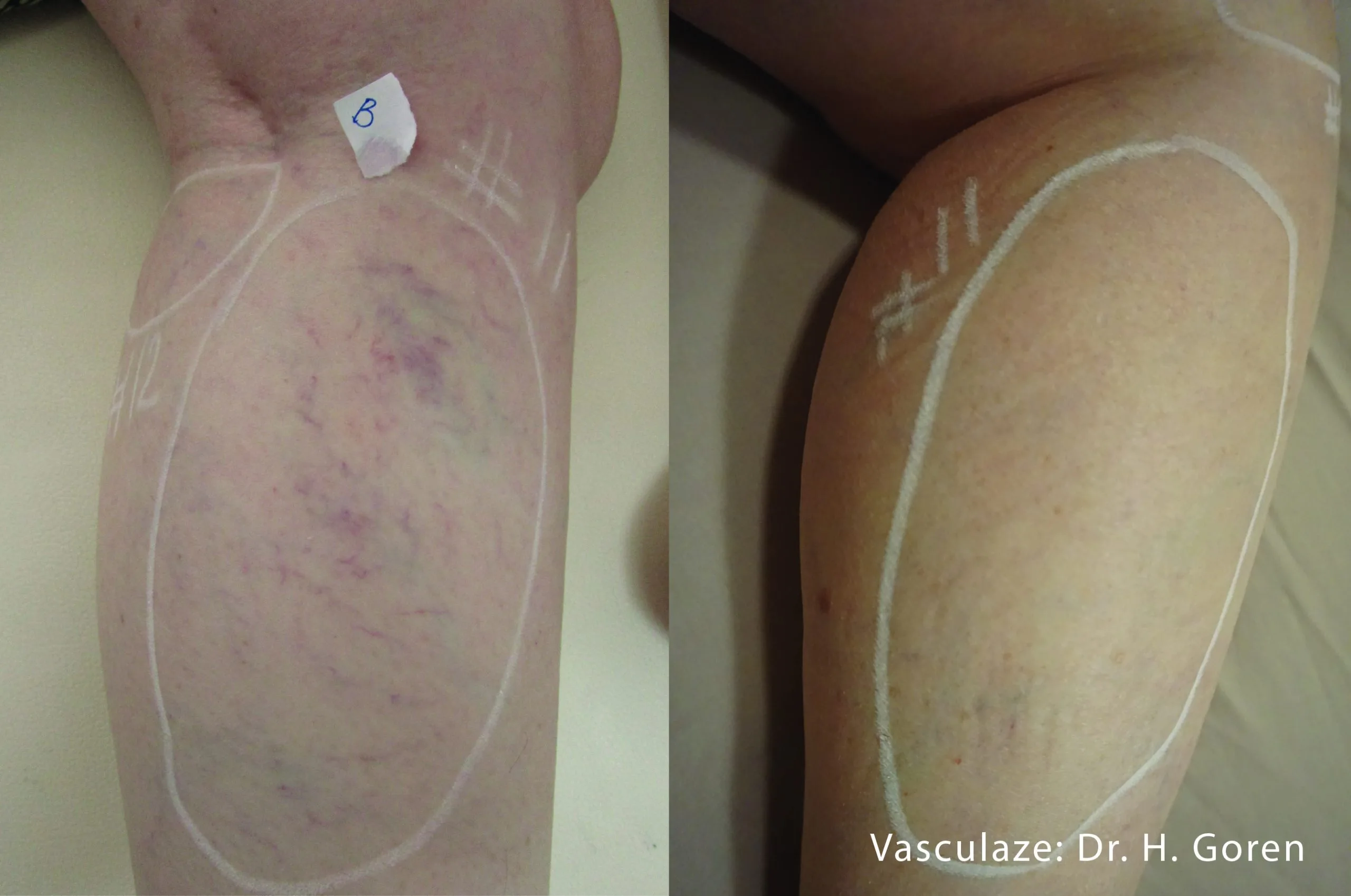 vein-treatment-before-after-sylmar-med-spa-in-sylmar-CA-five