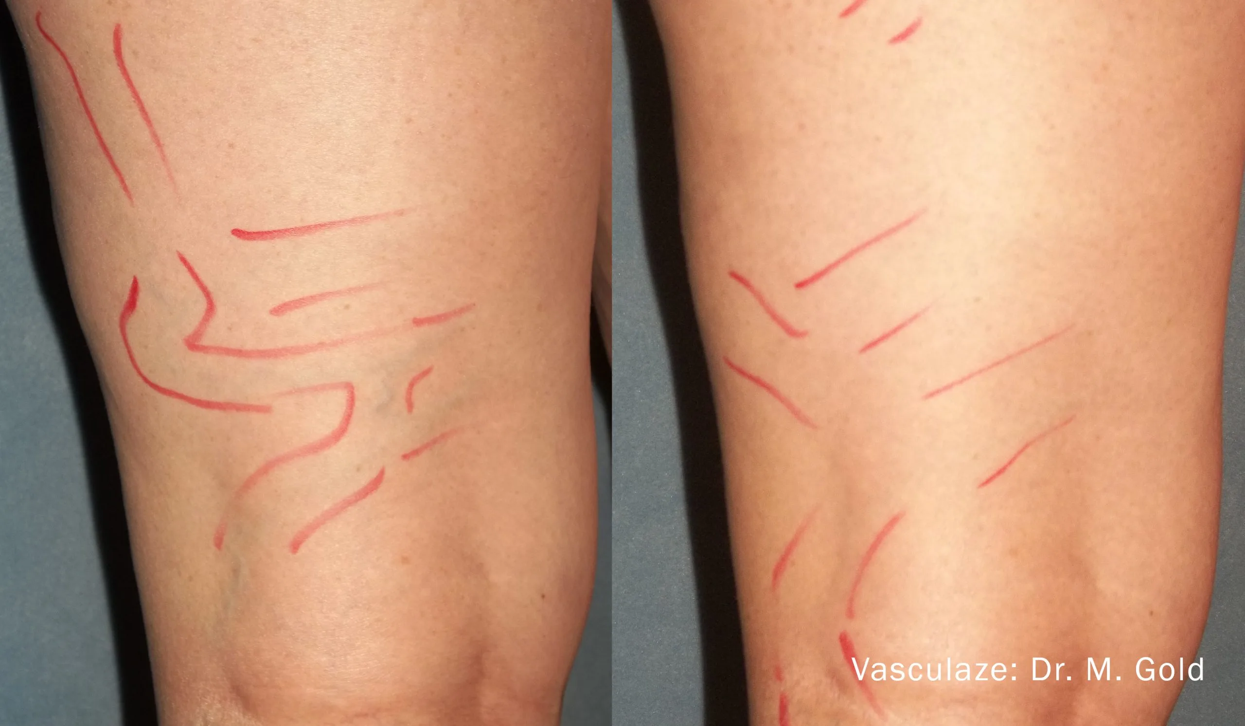 vein-treatment-before-after-sylmar-med-spa-in-sylmar-CA-four