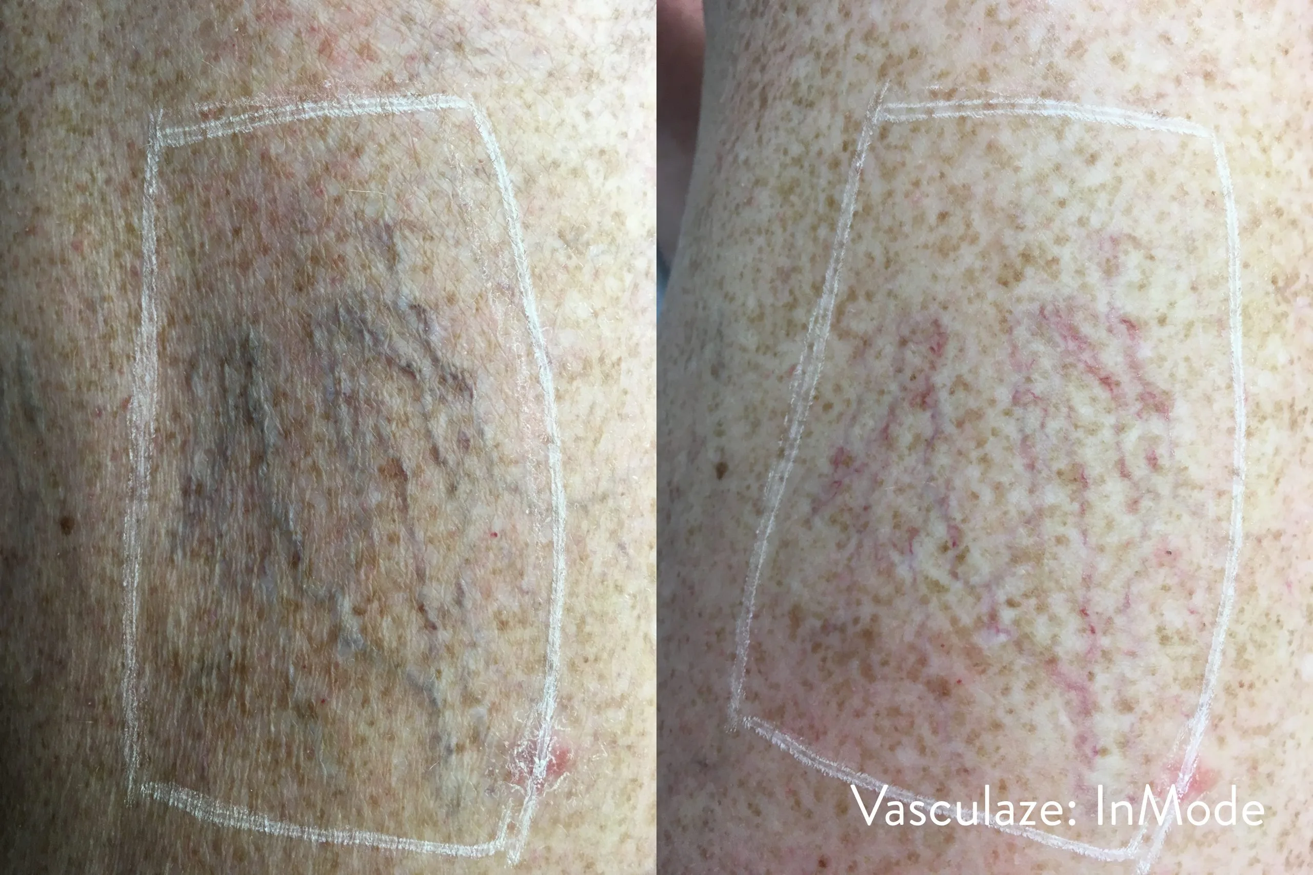 vein-treatment-before-after-sylmar-med-spa-in-sylmar-CA-seven