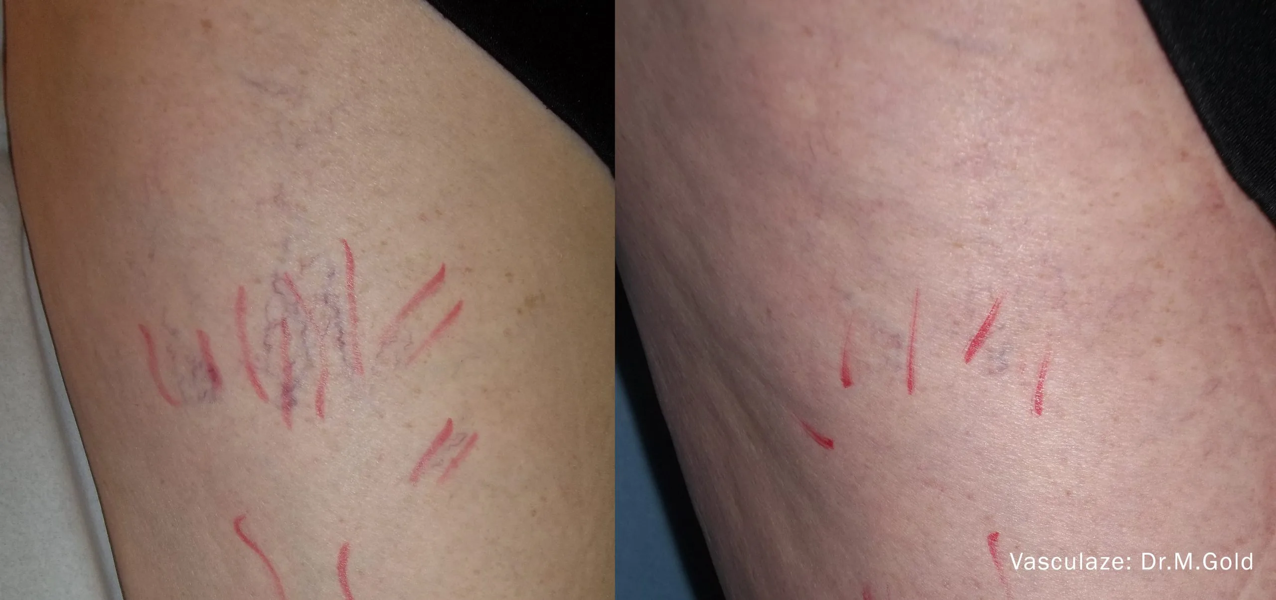 vein-treatment-before-after-sylmar-med-spa-in-sylmar-CA-six