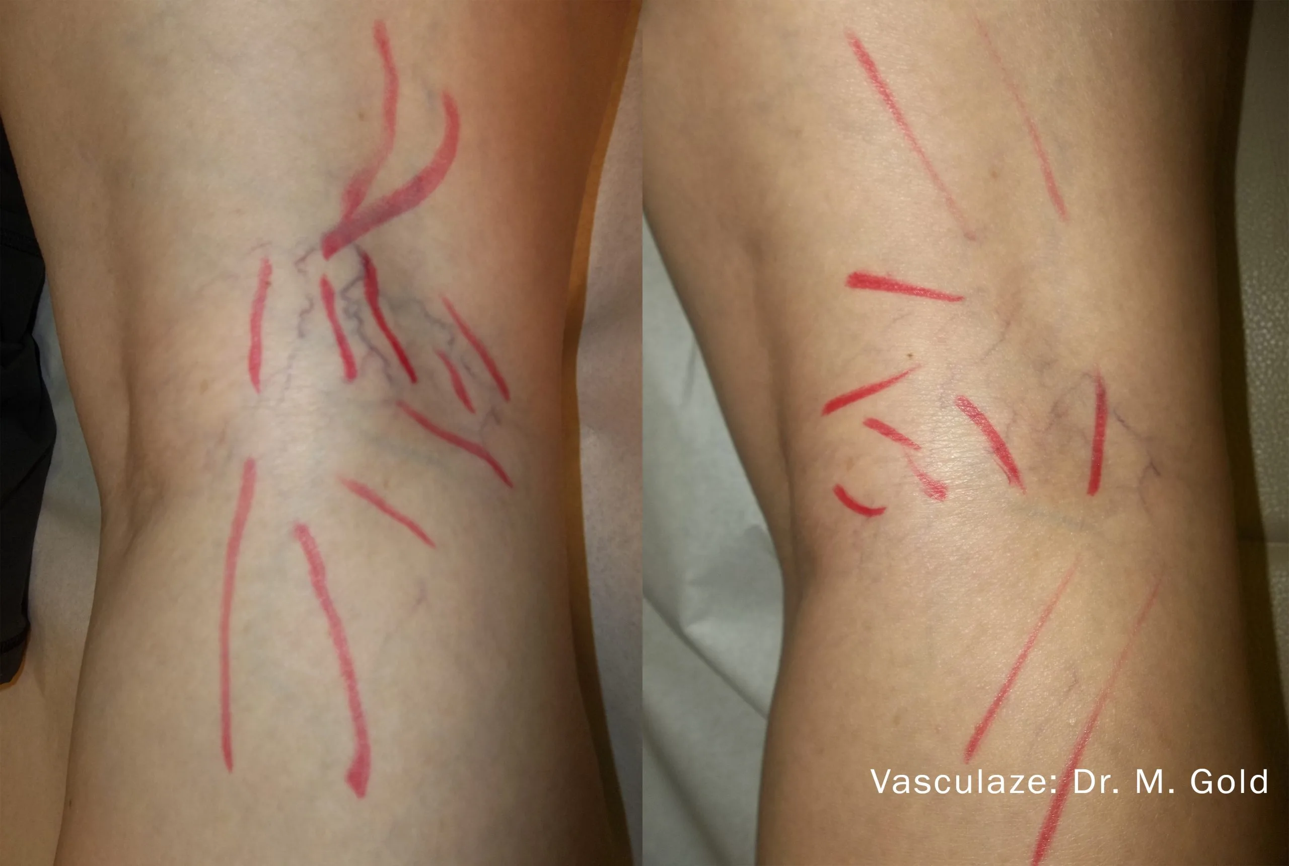 vein-treatment-before-after-sylmar-med-spa-in-sylmar-CA-three