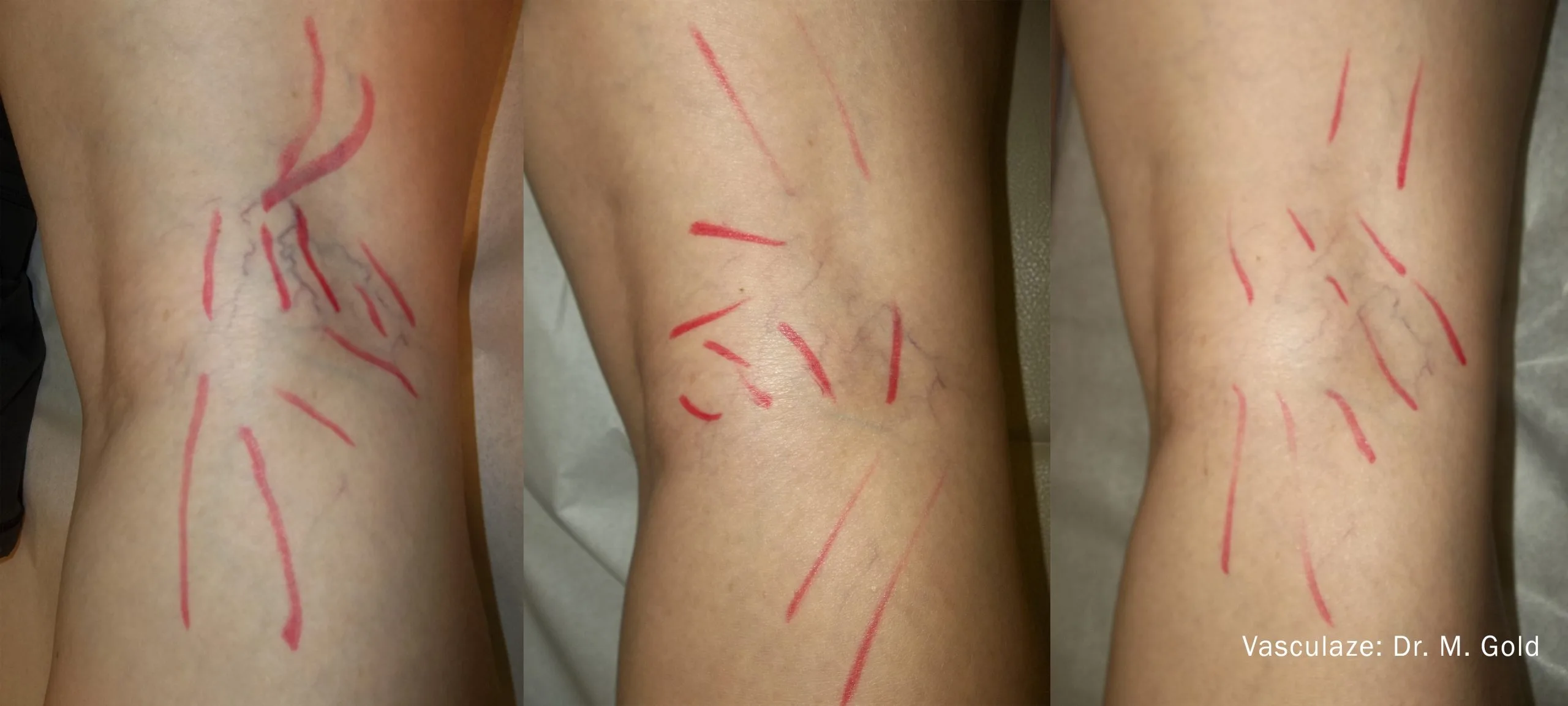 vein-treatment-before-after-sylmar-med-spa-in-sylmar-CA-two