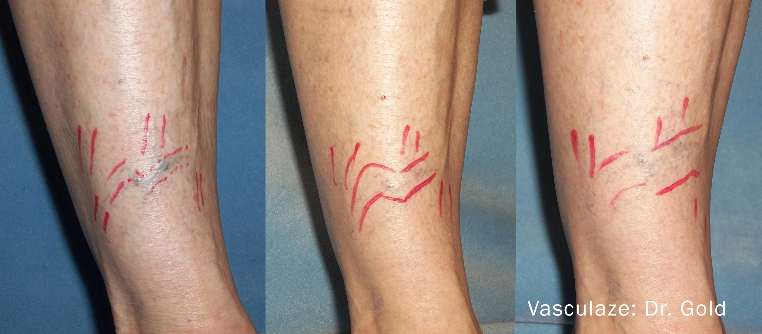 vein-treatment-before-after-sylmar-med-spa-in-sylmar-CA