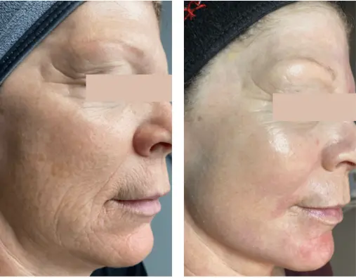 coolpeel-before-after-sylmar-med-spa-in-sylmar-CA-four