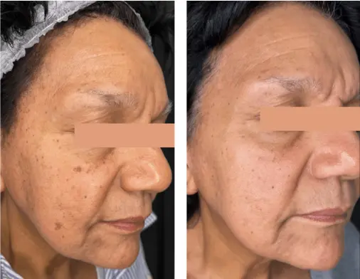 coolpeel-before-after-sylmar-med-spa-in-sylmar-CA