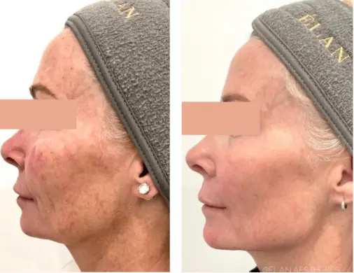 coolpeel-before-after-sylmar-med-spa-in-sylmar-CA-three