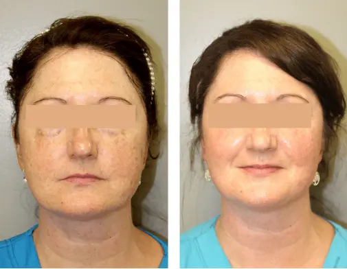 coolpeel-before-after-sylmar-med-spa-in-sylmar-CA-two