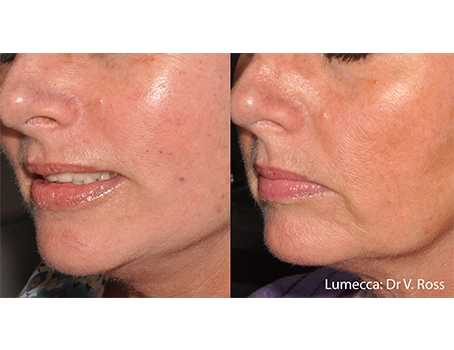 lumeca-before-after-sylmar-med-spa-in-sylmar-CA-eight