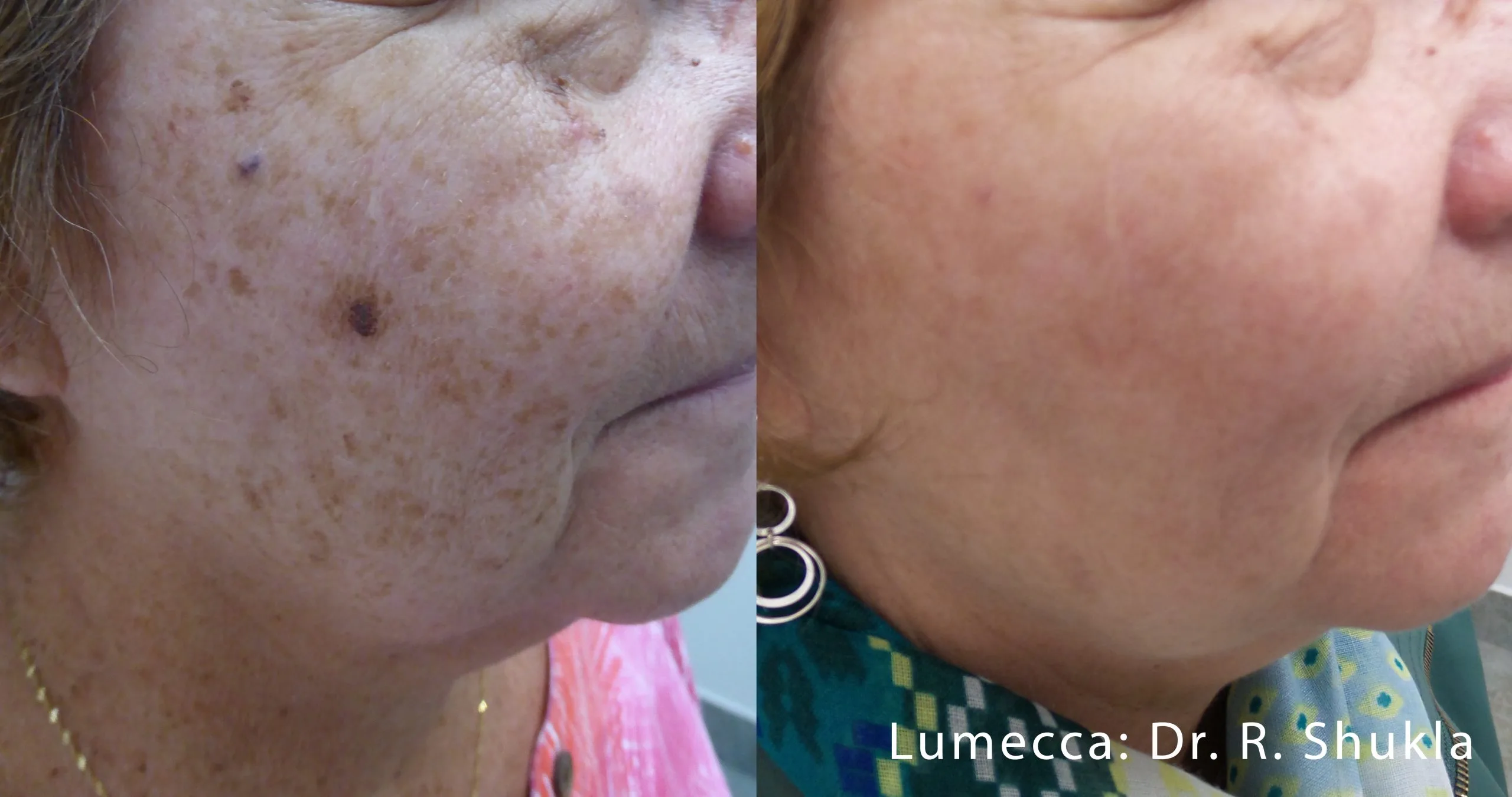 lumeca-before-after-sylmar-med-spa-in-sylmar-CA-eighteen