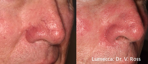 lumeca-before-after-sylmar-med-spa-in-sylmar-CA-eleven