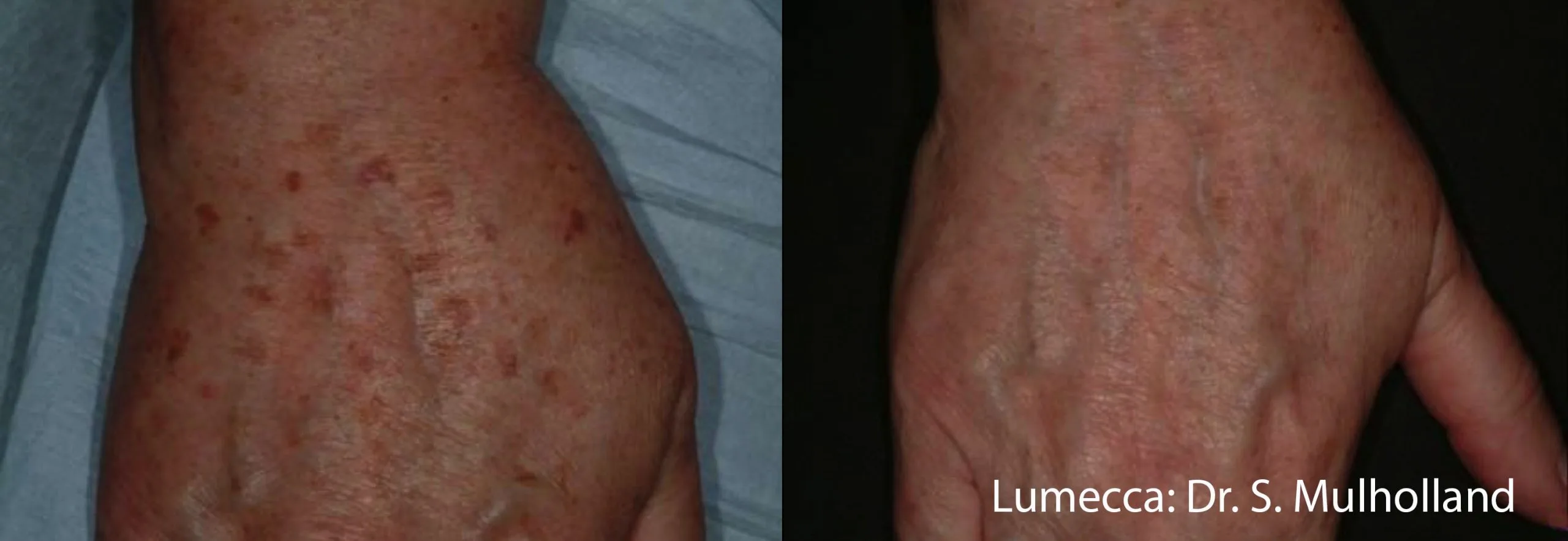 lumeca-before-after-sylmar-med-spa-in-sylmar-CA-fifteen