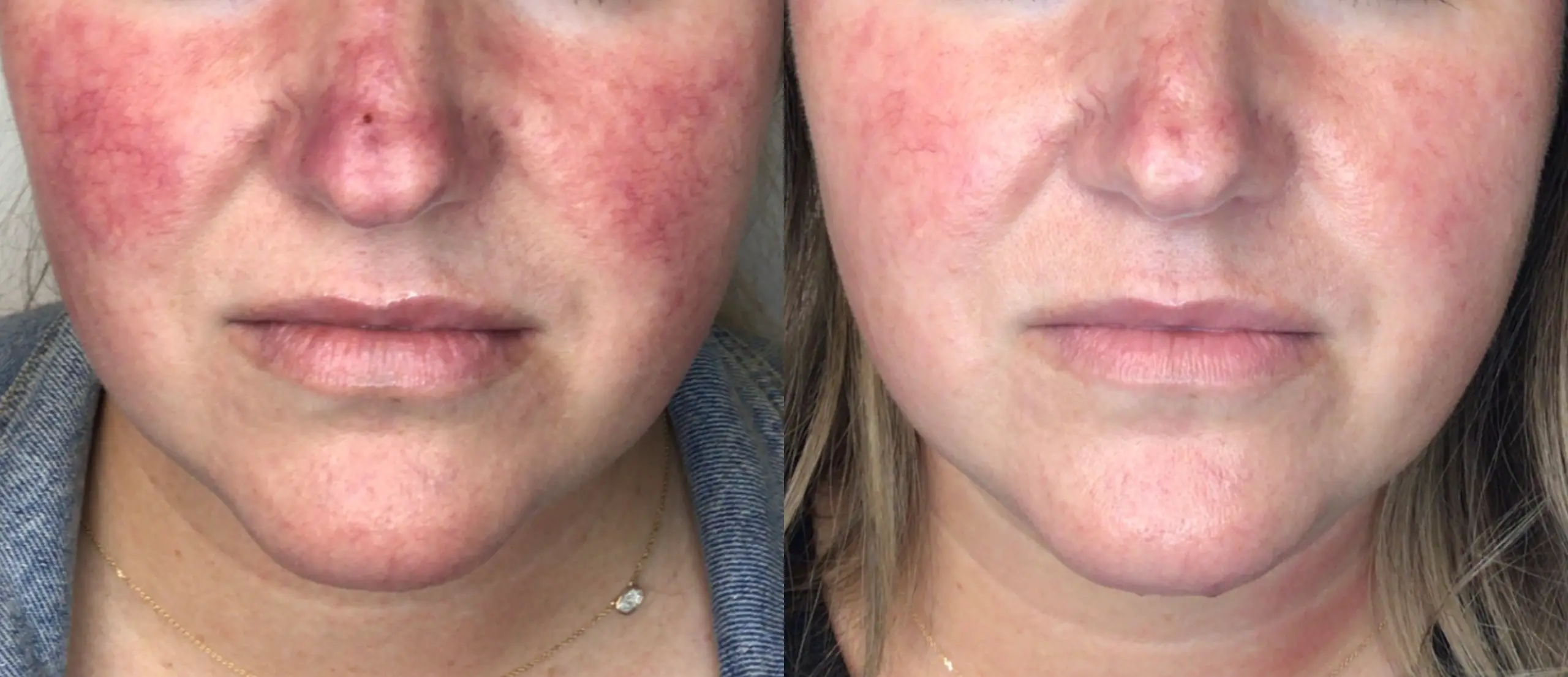 lumeca-before-after-sylmar-med-spa-in-sylmar-CA-five