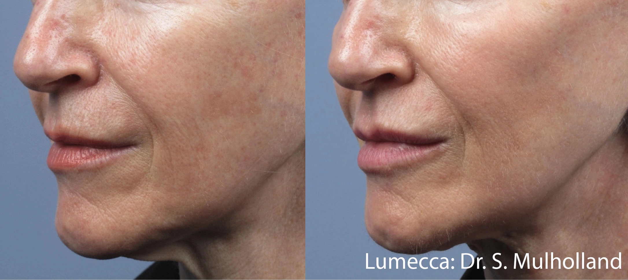 lumeca-before-after-sylmar-med-spa-in-sylmar-CA-forteen