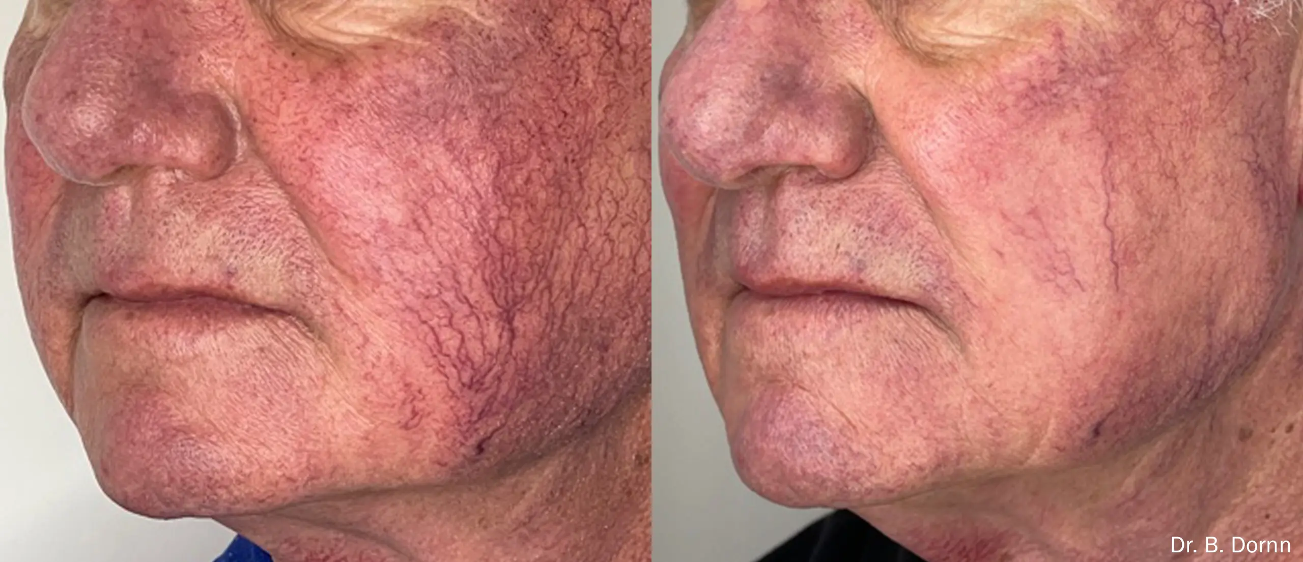 lumeca-before-after-sylmar-med-spa-in-sylmar-CA-forty