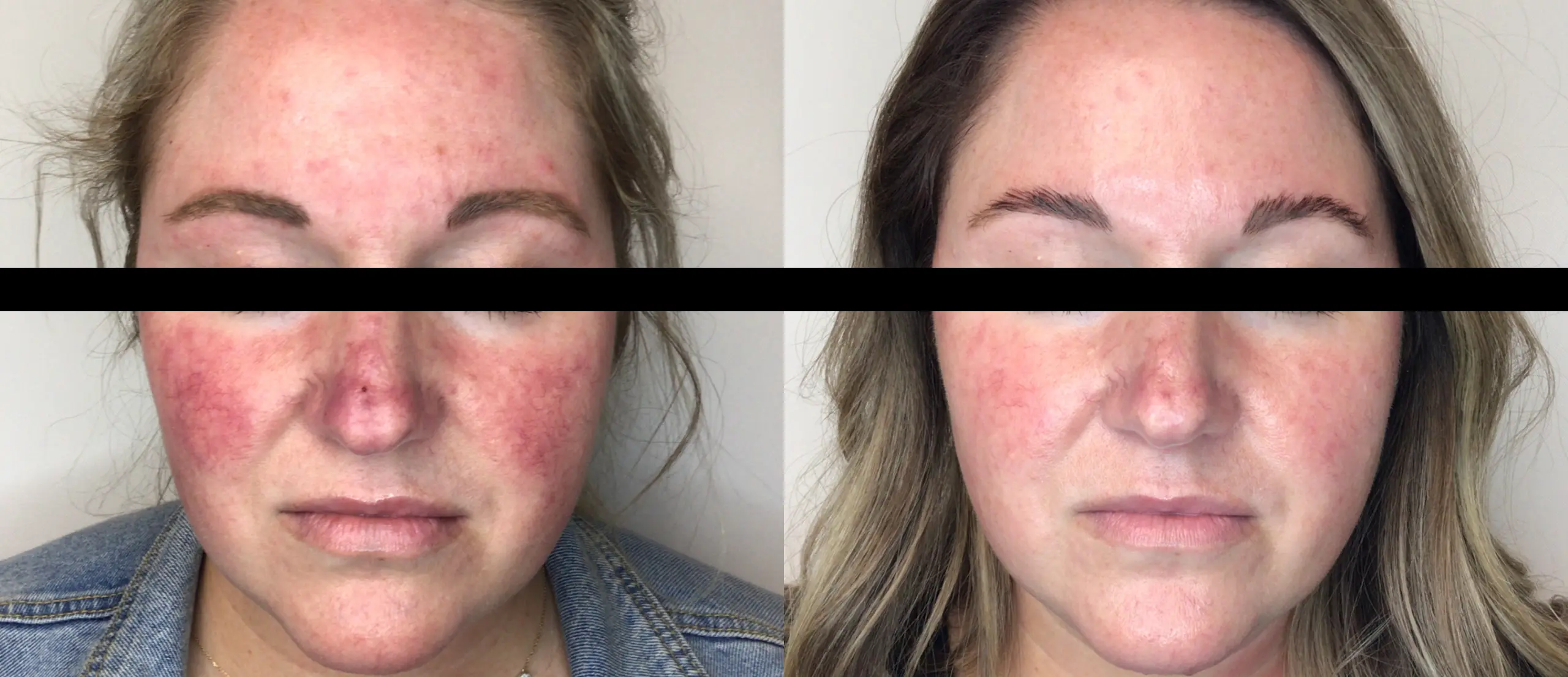 lumeca-before-after-sylmar-med-spa-in-sylmar-CA-four