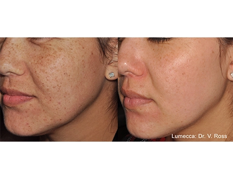 lumeca-before-after-sylmar-med-spa-in-sylmar-CA-nine