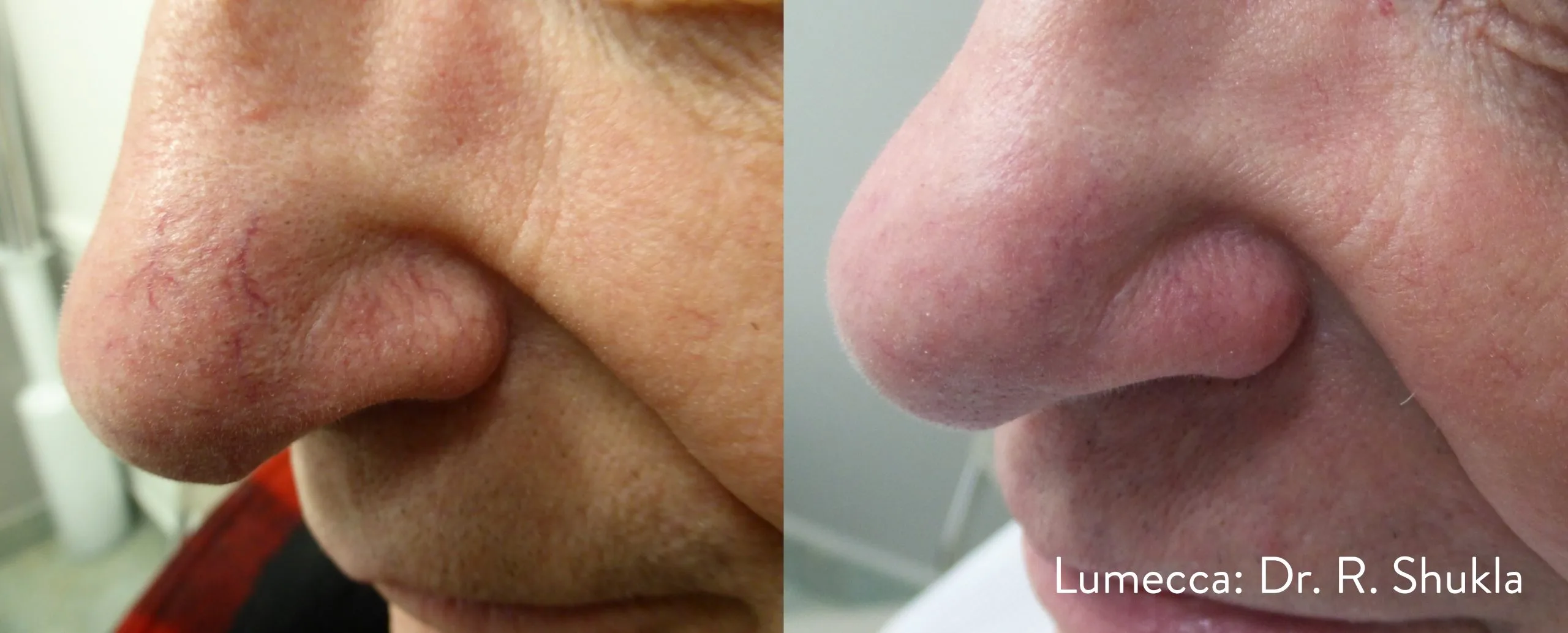 lumeca-before-after-sylmar-med-spa-in-sylmar-CA-nineteen