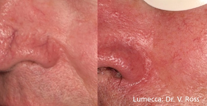 lumeca-before-after-sylmar-med-spa-in-sylmar-CA-seven