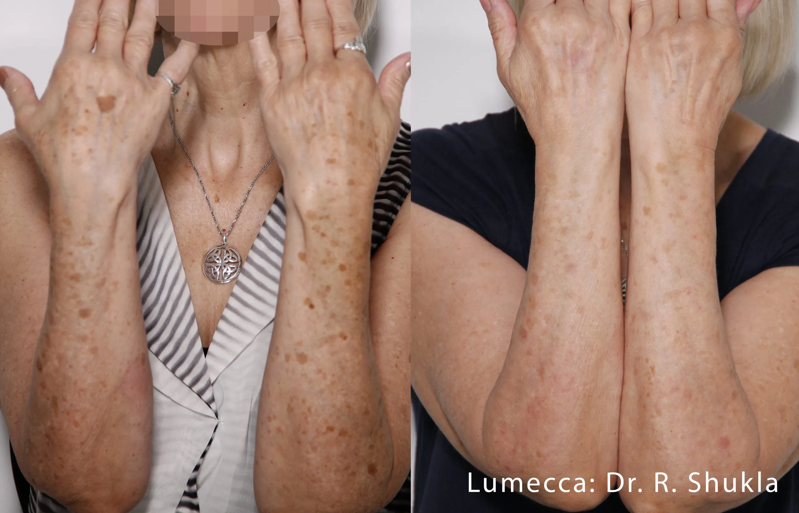 lumeca-before-after-sylmar-med-spa-in-sylmar-CA-seventeen