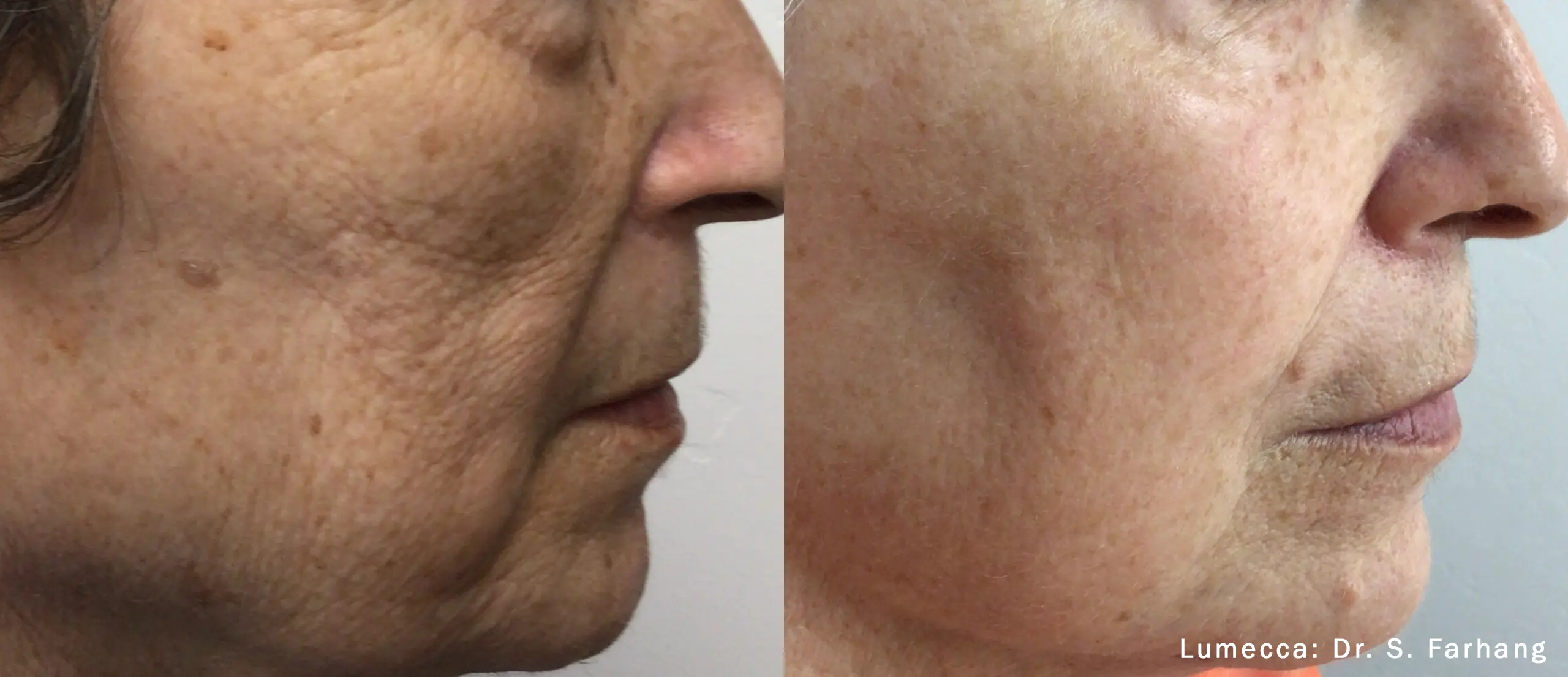 lumeca-before-after-sylmar-med-spa-in-sylmar-CA-sixteen