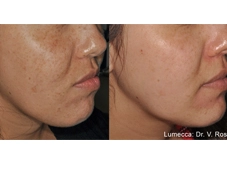 lumeca-before-after-sylmar-med-spa-in-sylmar-CA-ten