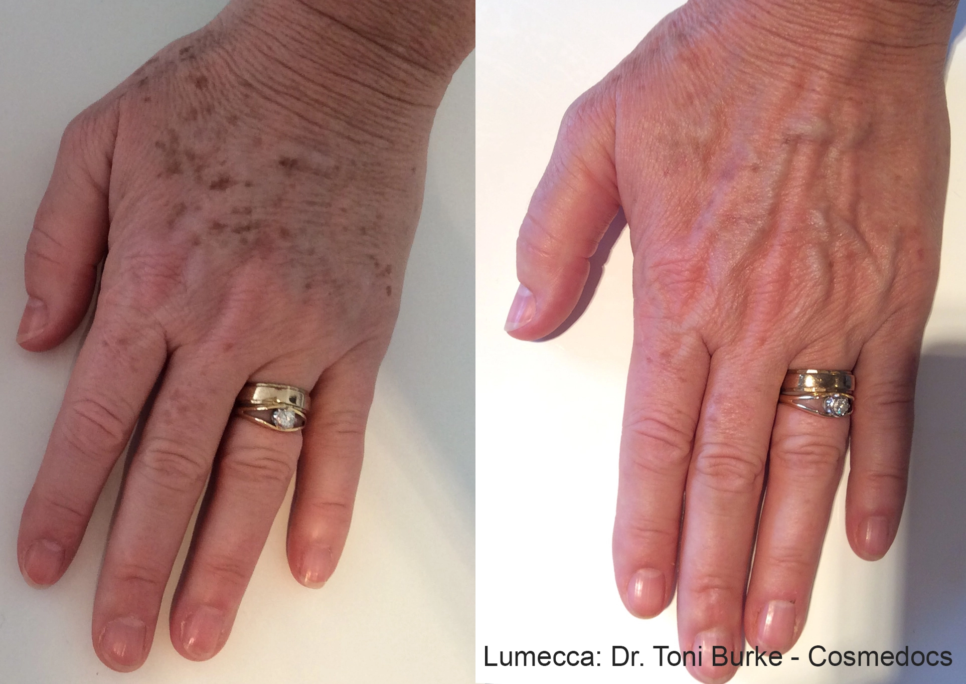 lumeca-before-after-sylmar-med-spa-in-sylmar-CA-thirteen