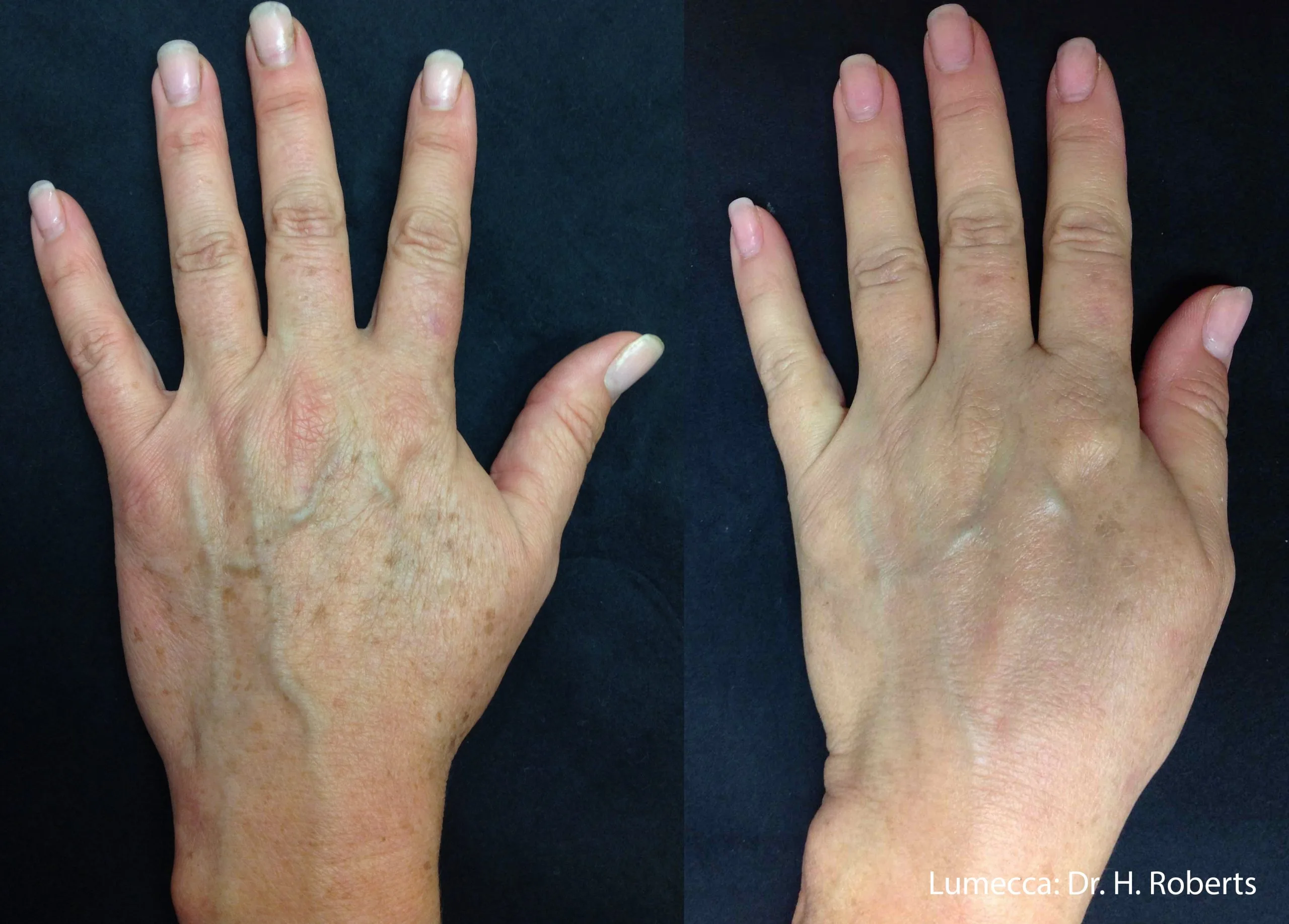 lumeca-before-after-sylmar-med-spa-in-sylmar-CA-thirty-eight