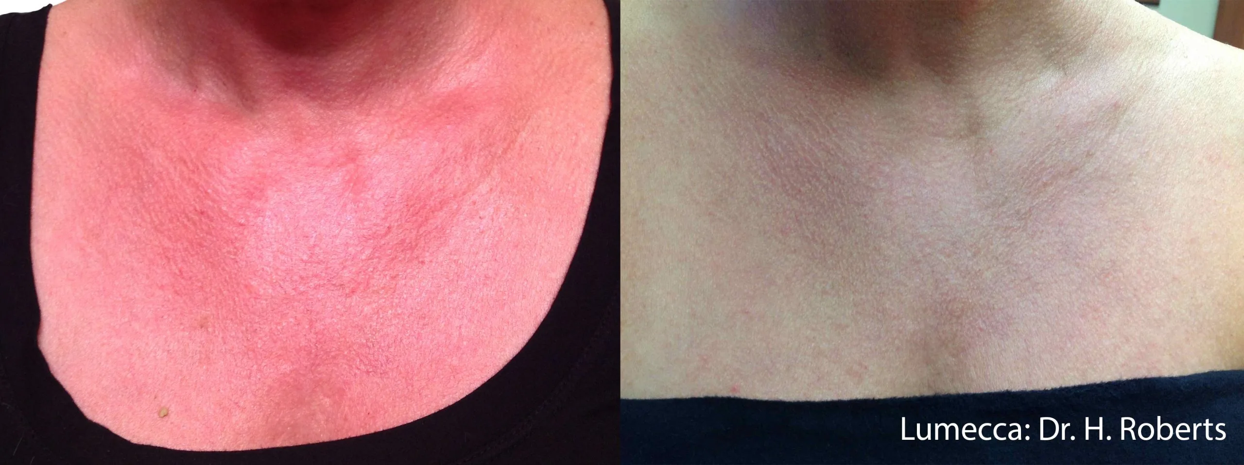 lumeca-before-after-sylmar-med-spa-in-sylmar-CA-thirty-five