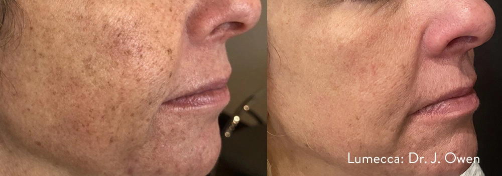 lumeca-before-after-sylmar-med-spa-in-sylmar-CA-thirty-four