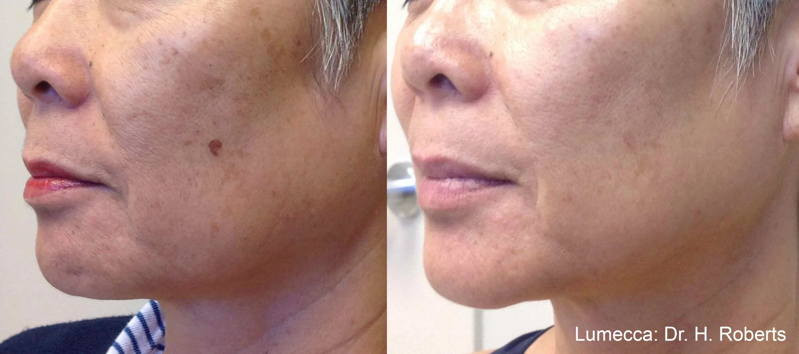 lumeca-before-after-sylmar-med-spa-in-sylmar-CA-thirty-nine