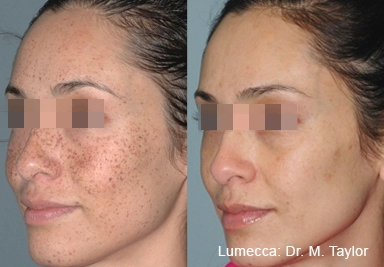 lumeca-before-after-sylmar-med-spa-in-sylmar-CA-thirty-one