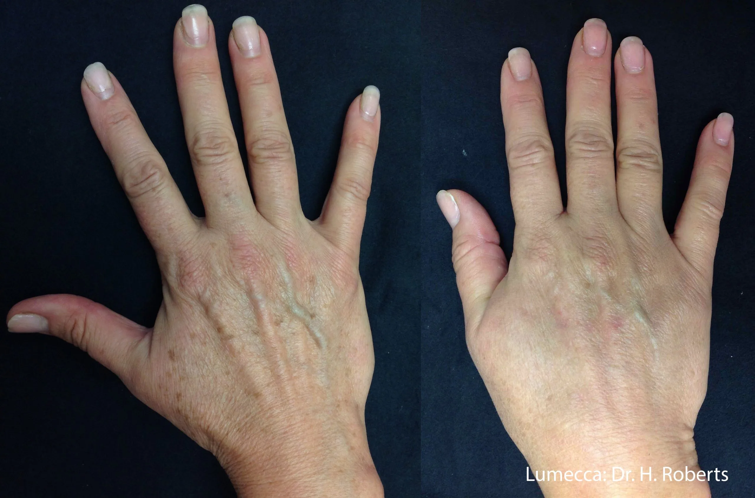 lumeca-before-after-sylmar-med-spa-in-sylmar-CA-thirty-seven