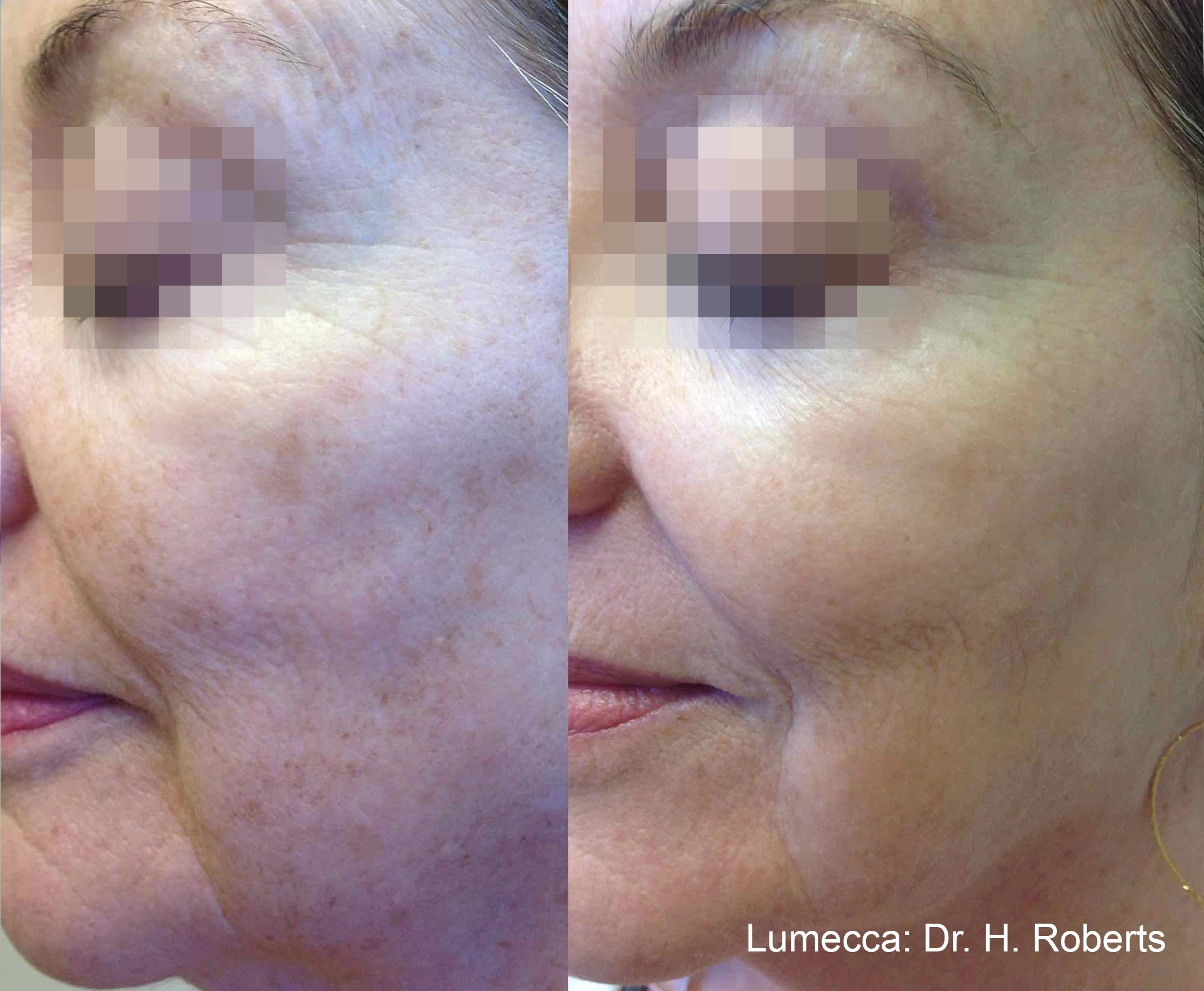 lumeca-before-after-sylmar-med-spa-in-sylmar-CA-thirty-six