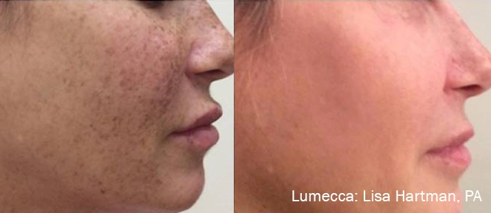 lumeca-before-after-sylmar-med-spa-in-sylmar-CA-thirty-three