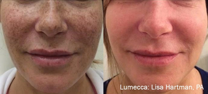 lumeca-before-after-sylmar-med-spa-in-sylmar-CA-thirty-two