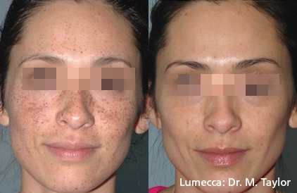 lumeca-before-after-sylmar-med-spa-in-sylmar-CA-thirty