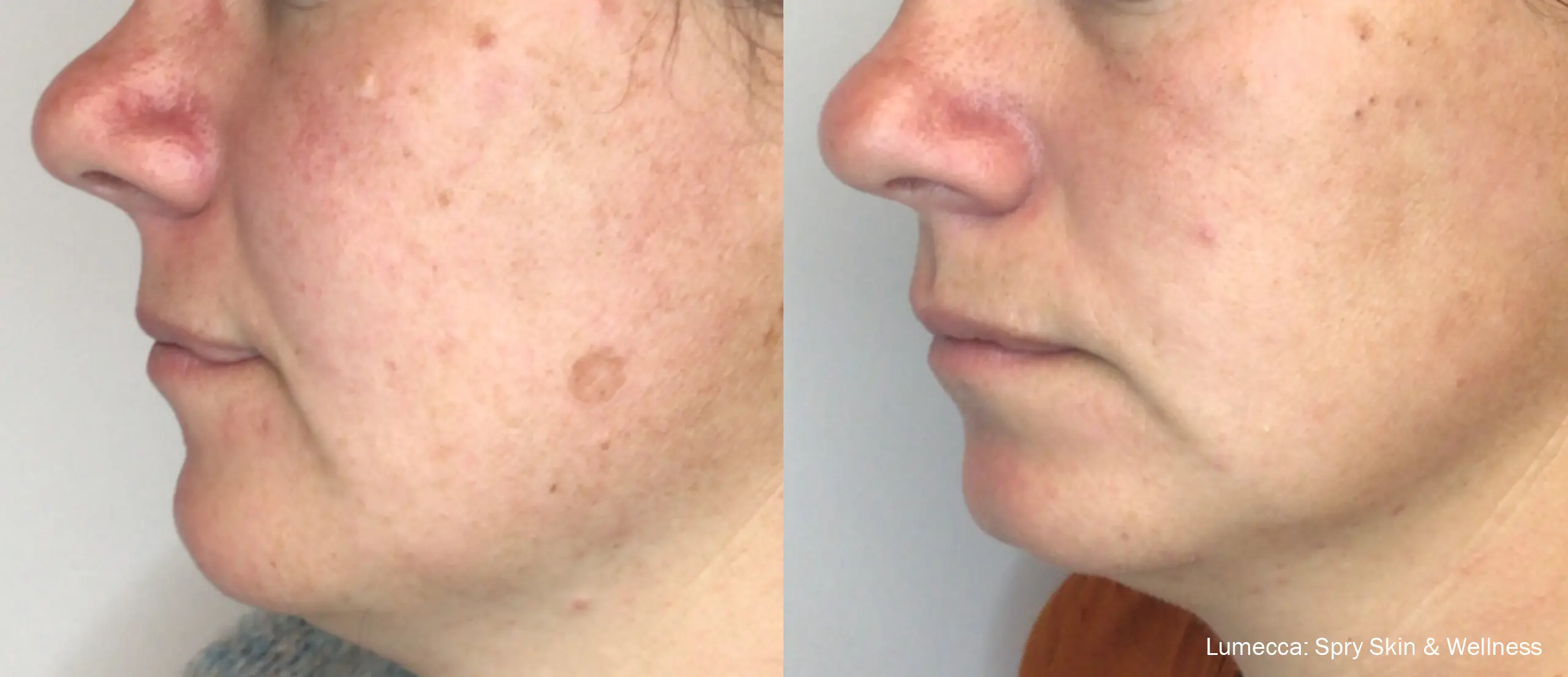 lumeca-before-after-sylmar-med-spa-in-sylmar-CA-three