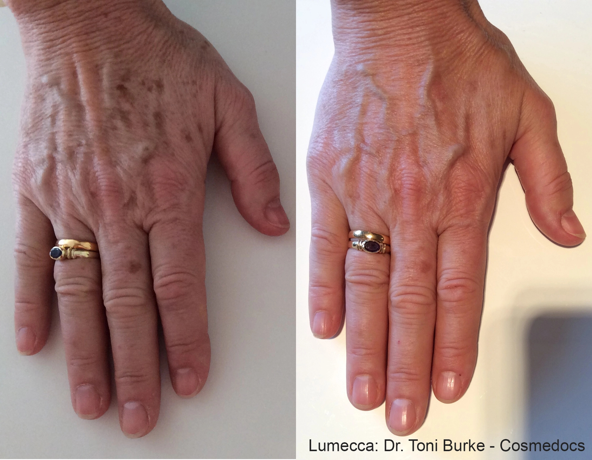 lumeca-before-after-sylmar-med-spa-in-sylmar-CA-twelve