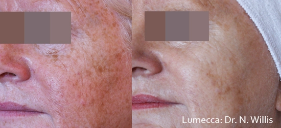 lumeca-before-after-sylmar-med-spa-in-sylmar-CA-twenty-eight