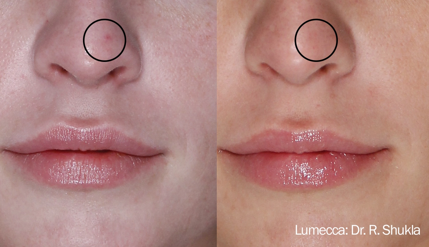 lumeca-before-after-sylmar-med-spa-in-sylmar-CA-twenty-five