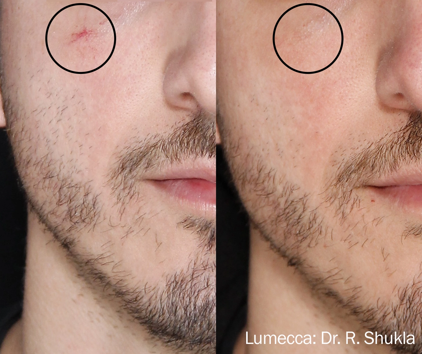 lumeca-before-after-sylmar-med-spa-in-sylmar-CA-twenty-four