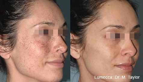 lumeca-before-after-sylmar-med-spa-in-sylmar-CA-twenty-nine