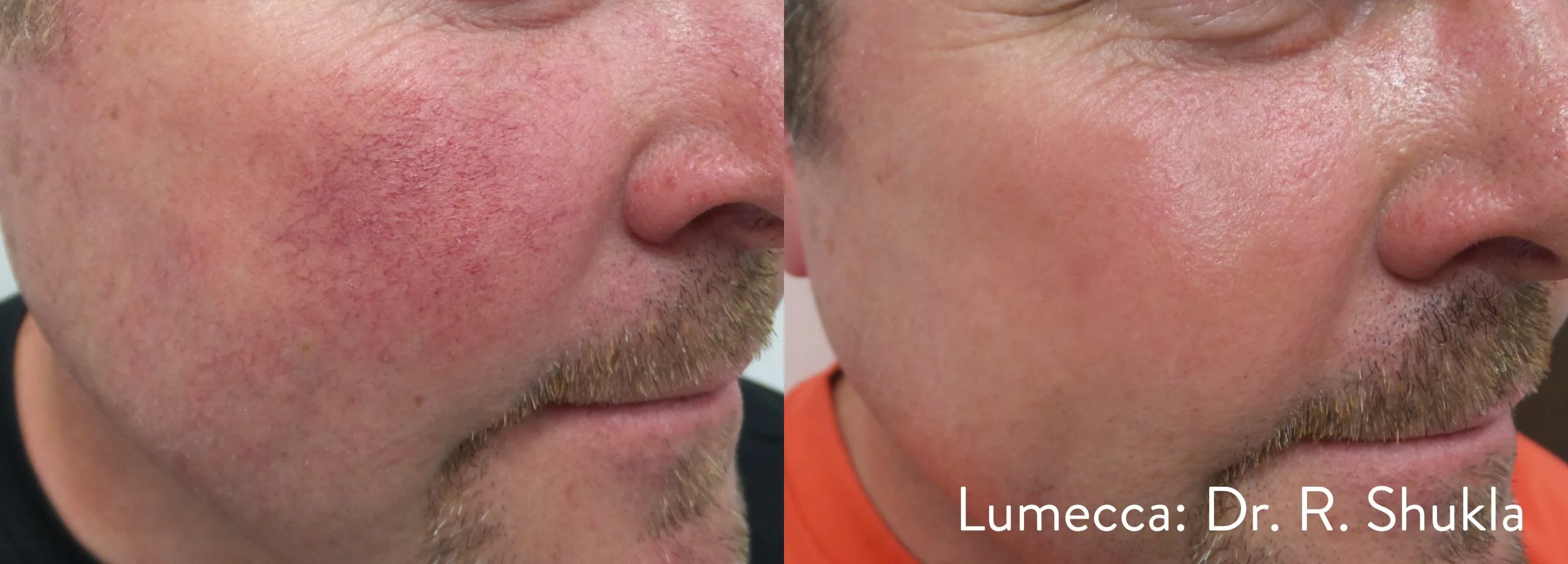 lumeca-before-after-sylmar-med-spa-in-sylmar-CA-twenty-one