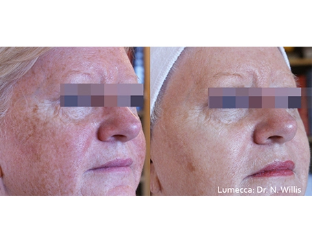 lumeca-before-after-sylmar-med-spa-in-sylmar-CA-twenty-seven