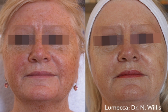 lumeca-before-after-sylmar-med-spa-in-sylmar-CA-twenty-six