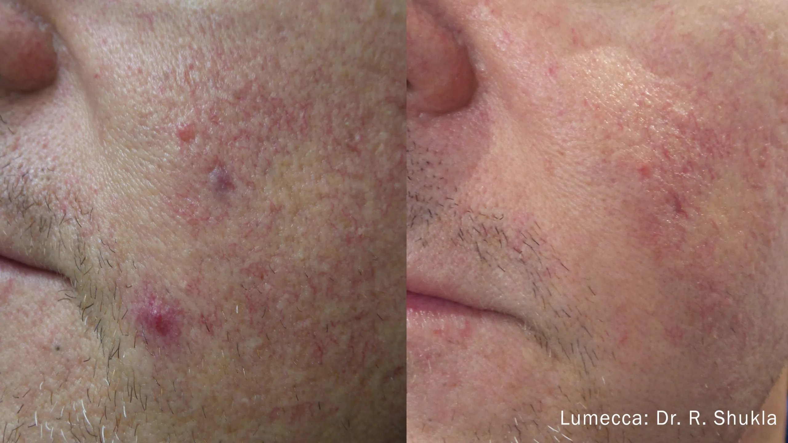 lumeca-before-after-sylmar-med-spa-in-sylmar-CA-twenty-three