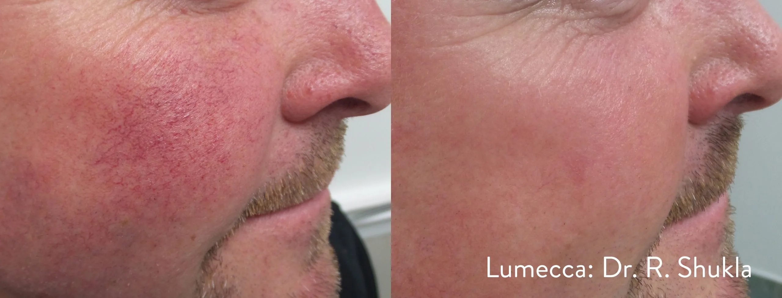 lumeca-before-after-sylmar-med-spa-in-sylmar-CA-twenty-two