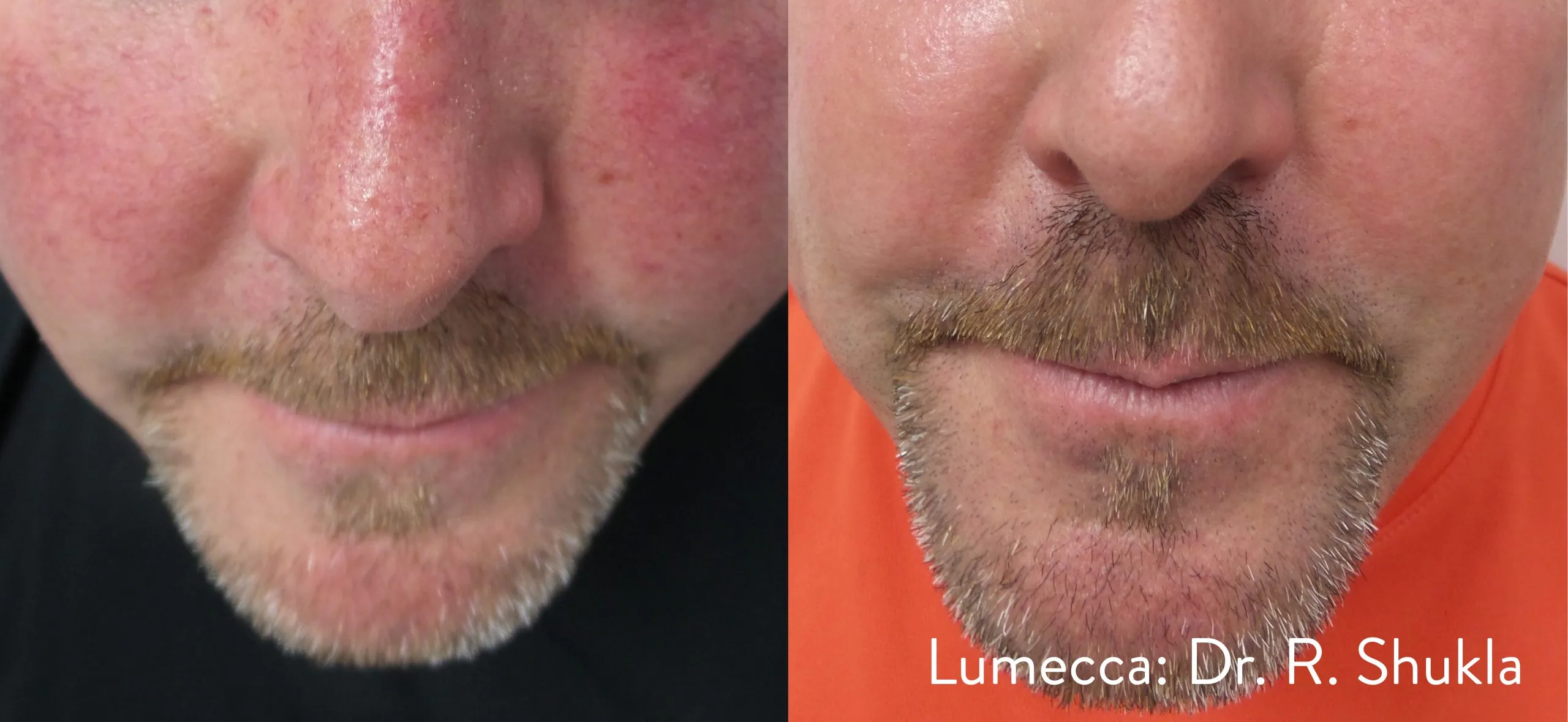 lumeca-before-after-sylmar-med-spa-in-sylmar-CA-twenty